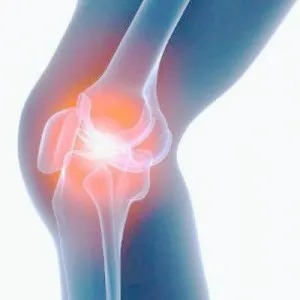 коленный артрит