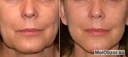 Botox Active Expert до и после