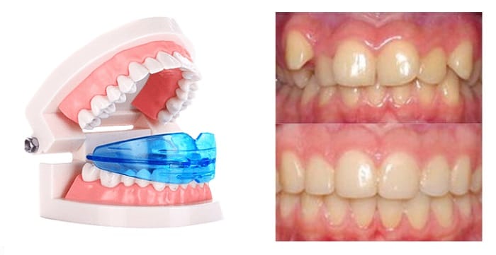 Dental Trainer для выравнивания зубов: добейтесь голливудской улыбки в домашних условиях!