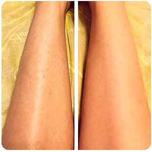 Женские ноги до и после применения depilight