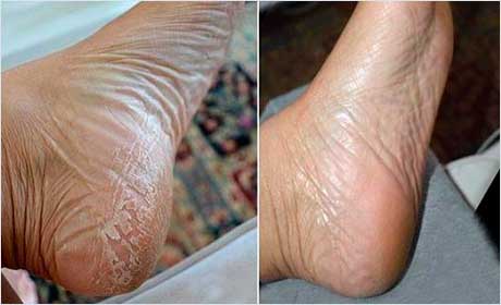 До и после использования носочков baby foot