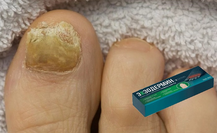 ЭКЗОДЕРМИН от грибка ногтей: растительный крем с мощными терапевтическими свойствами!