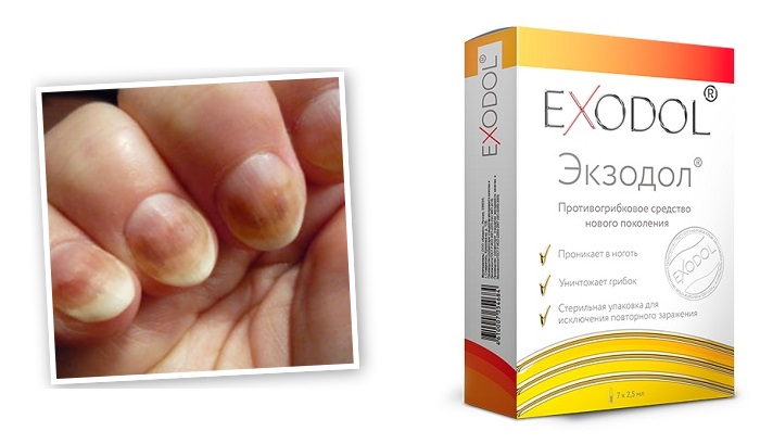 EXODOL от грибка ногтей: избавит от инфекции за считанные дни!