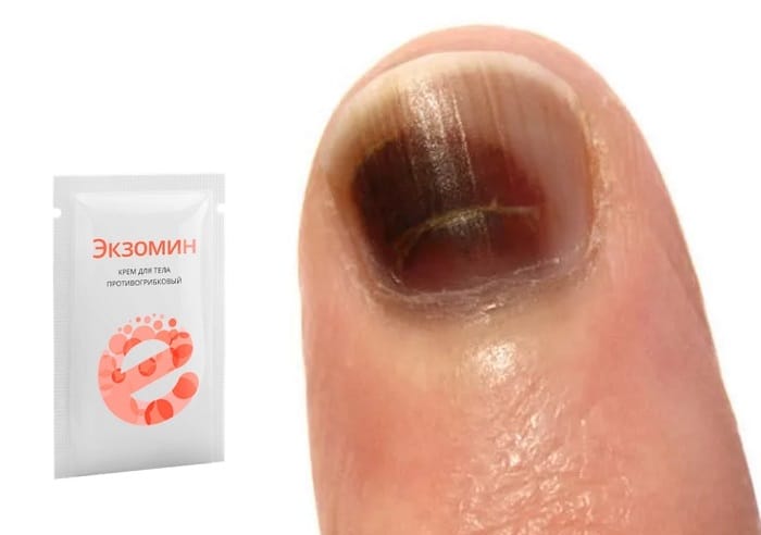 Экзомин от грибка ногтей: избавляет от неприятного запаха и излишней потливости ног!