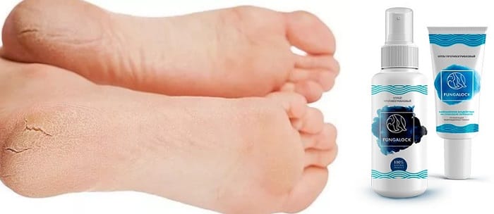 Fungalock от грибка ногтей и ног: высокорезультативное средство на натуральной основе!