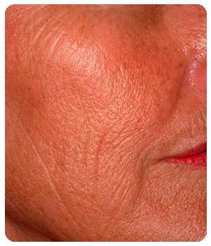 Состояние кожи лица до применения крема Гиалурин.