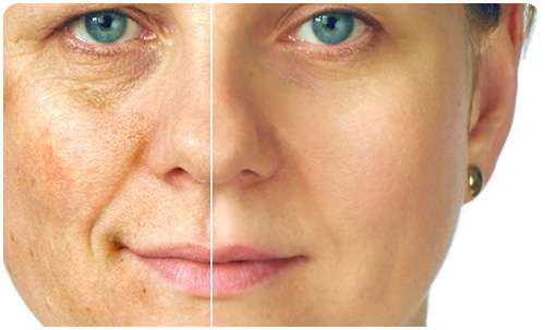 Лицо, до и после использования крем Люмидерм от пигментных пятен