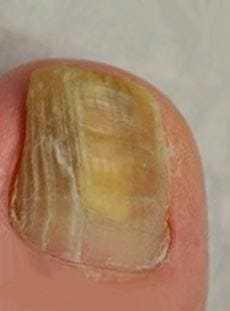 Опасность грибка ногтей