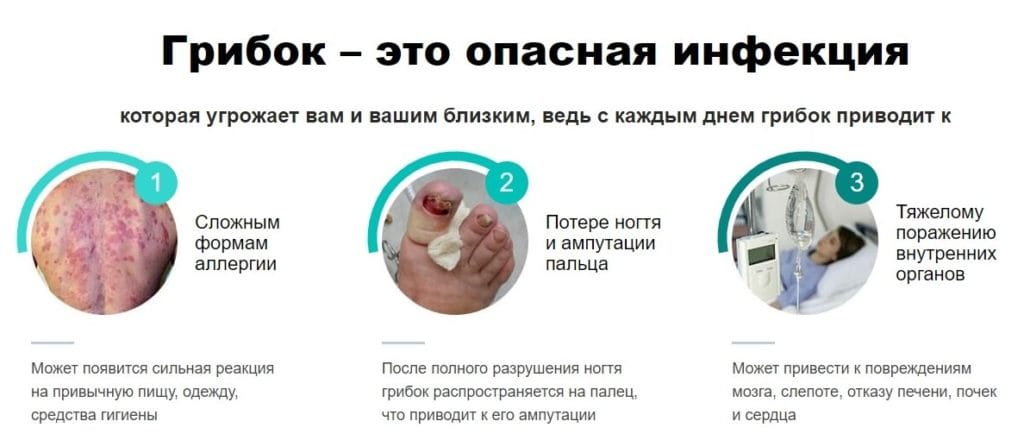 ΠΠΈΠΊΠΎΠ΄Π΅Ρ ΠΎΡ Π³ΡΠΈΠ±ΠΊΠ° Π½ΠΎΠ³ΡΠ΅ΠΉ ΠΎΡ ΡΠ΅Π³ΠΎ
