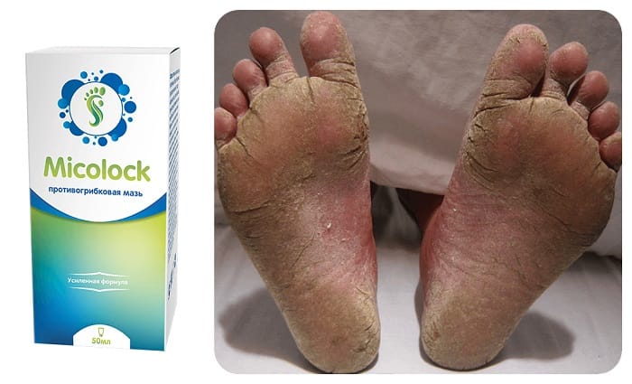 Micolock от грибка ногтей и ног: работает без побочных эффектов и противопоказаний в любом возрасте!