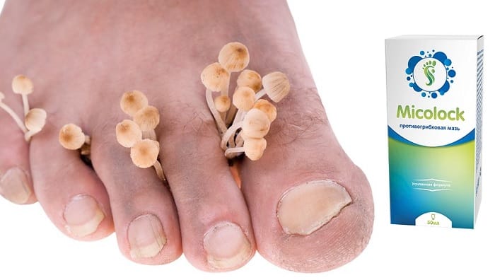 Micolock от грибка ногтей и ног: действует и защищает 24 часа в сутки 7 дней в неделю!