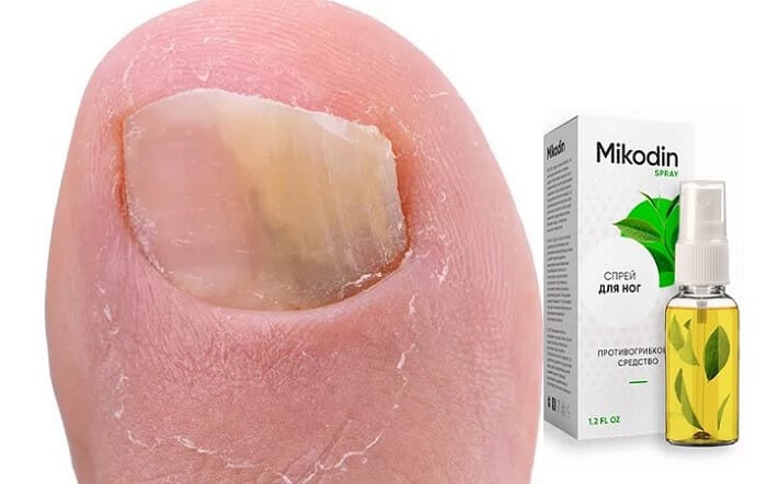 Микодин от грибка ногтей: вернет здоровье и красоту вашим ногтям и ступням!