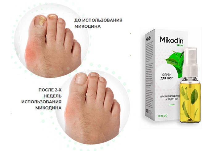 Микодин от грибка ногтей: забудьте о грибковой инфекции за считанные дни!