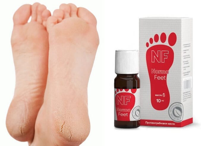 НормаФит масло от грибка ногтей и ног: не оставьте ни единого шанса инфекции!