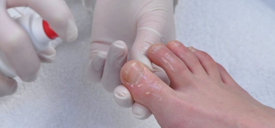Препарат Миколок – отзывы, цена мази от грибка ногтей