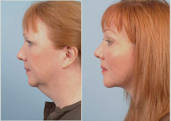 Результат до и после применения крема Chin-L