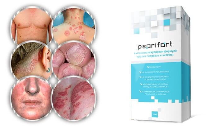 Psorifort от псориаза: избавит от болезни на любой ее стадии!