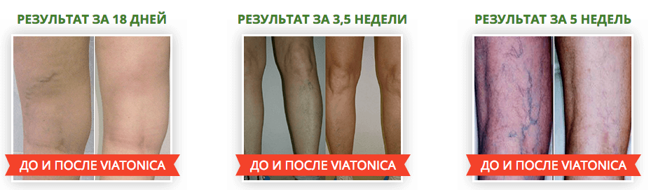 Viatonica от варикоза: снимает боль, отеки и воспаление за 1 курс!