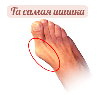 шишка на большом пальце ноге