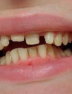 Snaponsmile для скрытия дефектов зубов