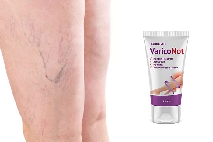 VaricoNot от варикоза: устраняет косметические дефекты без операций, уколов и химии!