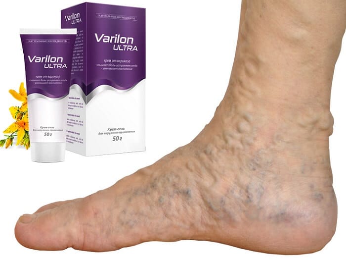 Varilon Ultra от варикоза: устраняет причину болезни и быстро приводит ножки в порядок!