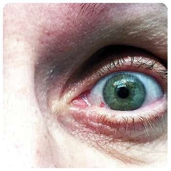 Благодаря лекарству VisuTabs глаз пришел в норму.