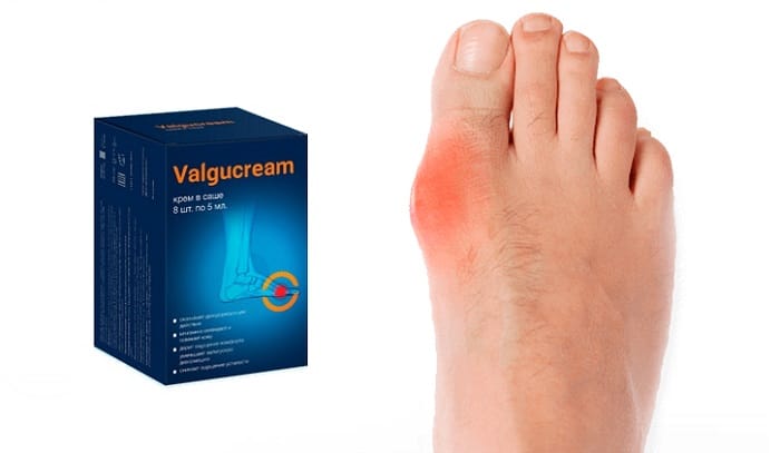 Valgucream для лечения вальгусной деформации стопы: избавьтесь от дефекта без операции!