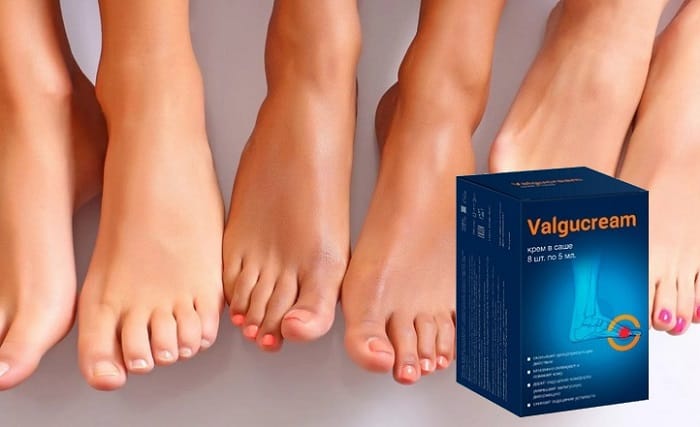 Valgucream для лечения вальгусной деформации стопы: избавьтесь от дефекта без операции!