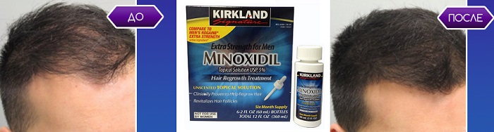 MINOXIDIL для густой шевелюры: сильные и густые волосы за 1 месяц!